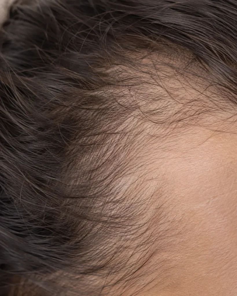 Capelli Fini e Deboli